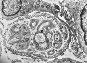 M, 3y. | cutaneous nerve